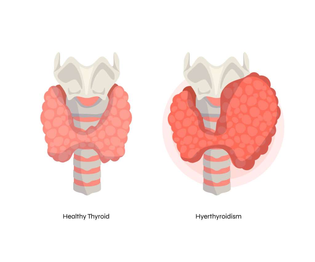 Thyroid Storm: Causes, Symptoms, Diagnosis & Treatment