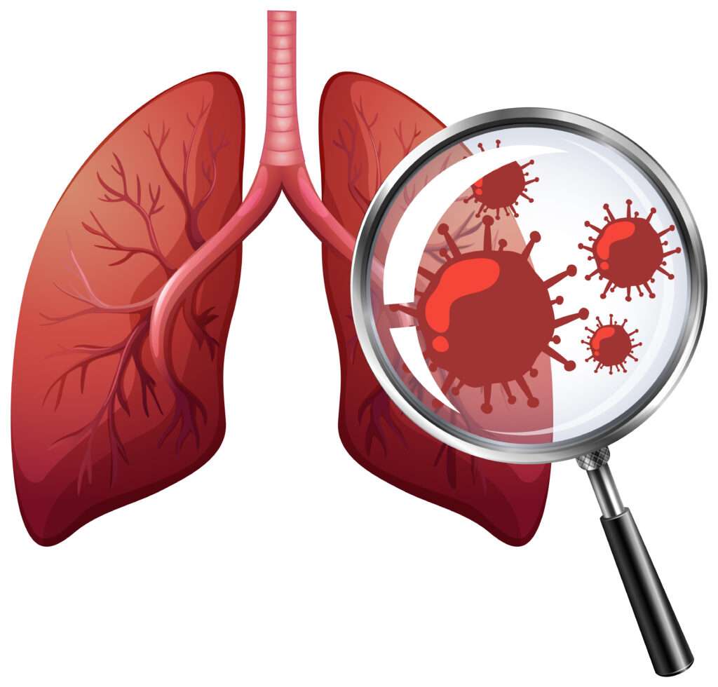 Pneumonia: Considerations for the Critically Ill Patient